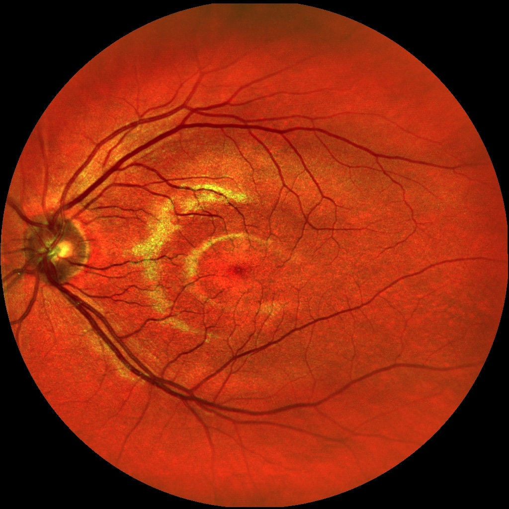 Scan eines Auges beim Augenoptiker